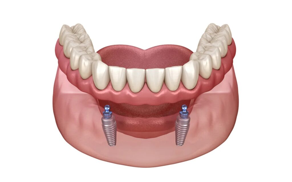 Snap on denture 1
