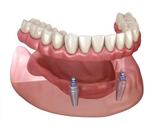 Snap on denture 2